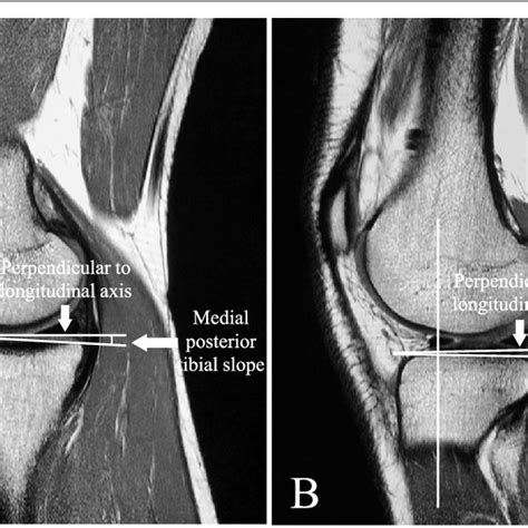 A Medial Posterior Tibial Slope At The Central Sagittal Plane Of The