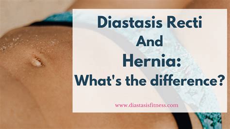 Diastasis Recti And Hernia What S The Difference