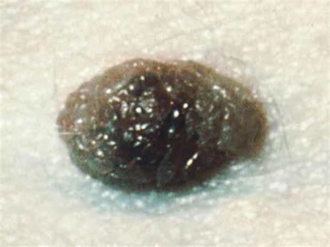 Common Moles Dysplastic Nevi And Risk Of Melanoma Nci