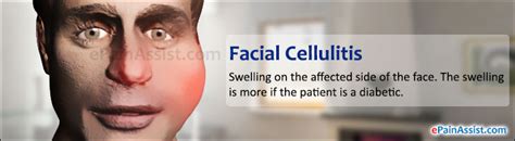 Facial Cellulitiscausesrisk Factorssignssymptomsinvestigations