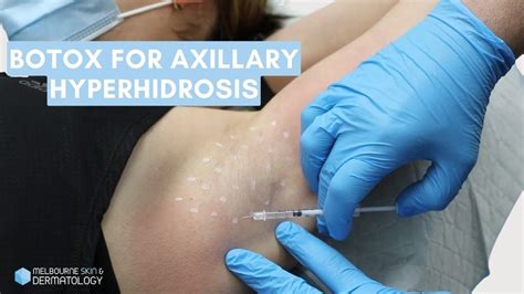 Botox For Axillary Hyperhidrosis Melbourne Skin And Dermatology Youtube