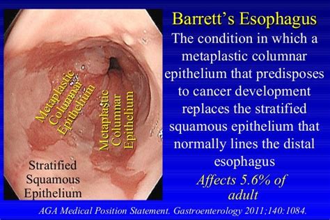 stages of barrett s esophagus