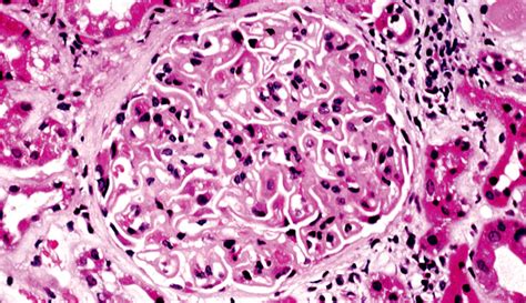 Idiopathic Membranous Nephropathy Back To The Future The Lancet