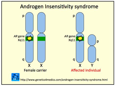 Androgen Insensitivity Syndrome Genetics 4 Medics