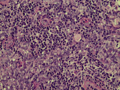 Primary Cutaneous Cd30 Anaplastic Large Cell Lymphoma Journal Of