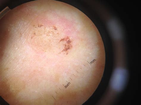 Seborrheic Keratosis