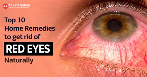 10 Natural Home Remedies To Soothe Your Bloodshot Eyes