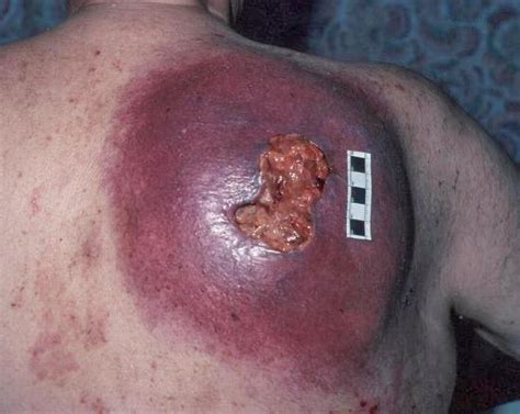 Overall, there are only about 150 cases of childhood cancer for every 1 million children in the united states. Symptoms Of Disease: Symptoms Disease Skin Cancer ...