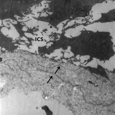 Clinical Photograph Showing Homogenous Leukoplakia Of Buccal Mucosa