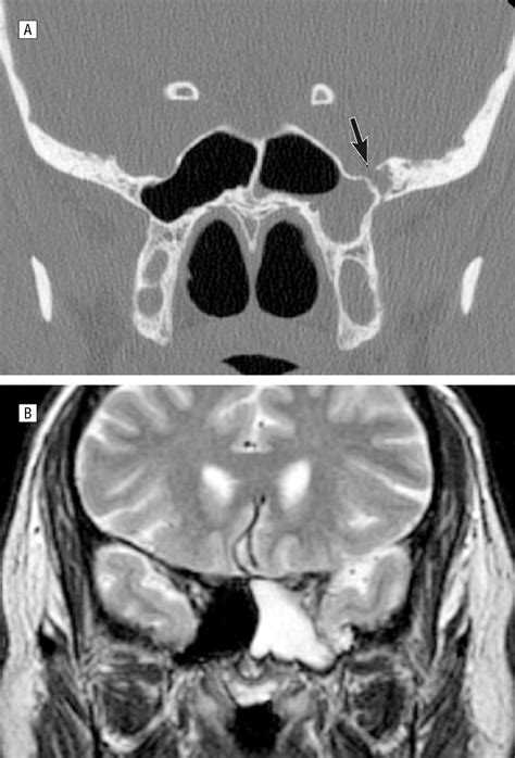 Evaluation And Surgical Management Of Isolated Sphenoid Sinus Disease