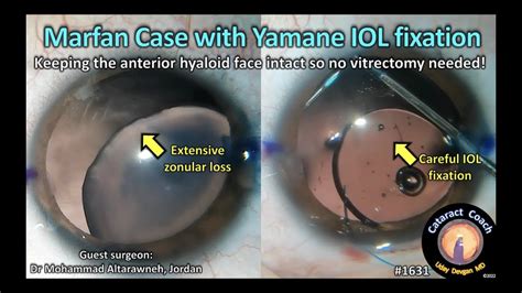 Cataractcoach 1631 Marfan Syndrome And Yamane Iol Fixation Youtube