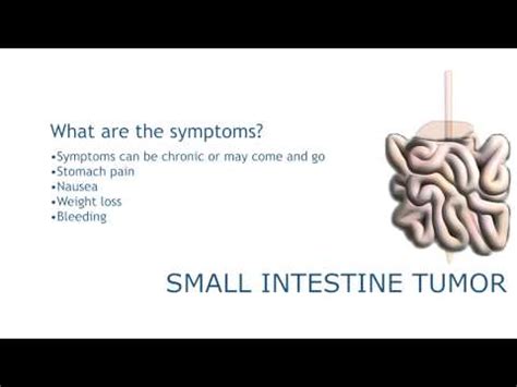 Small intestine biopsy samples can be obtained by: Small Intestine Cancer Health Byte