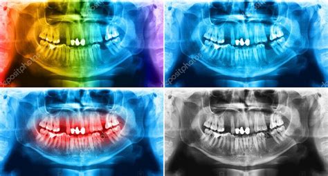 X Ray Teeth Mandible Human Skull — Stock Photo © Ifeelgood 119902054
