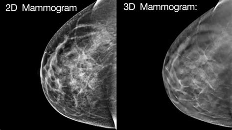 Huge Study Puts 3d Mammogram To The Test Youtube