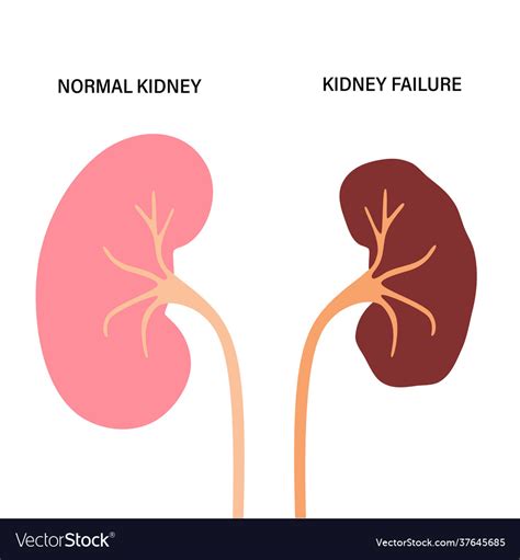 Kidney Disease Concept Royalty Free Vector Image