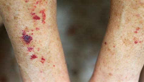 Put Off Ape Generally Blood Spots On Skin Pictures To Give Permission
