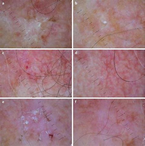 Figure 1 From Treatment Of Multiple Actinic Keratosis And Field Of
