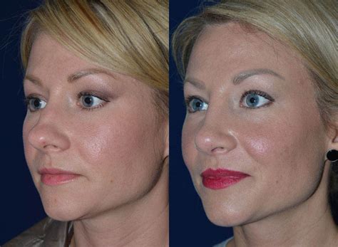 How To Fix A Wide Or Broad Nose Facial Surgery And Aesthetics Center