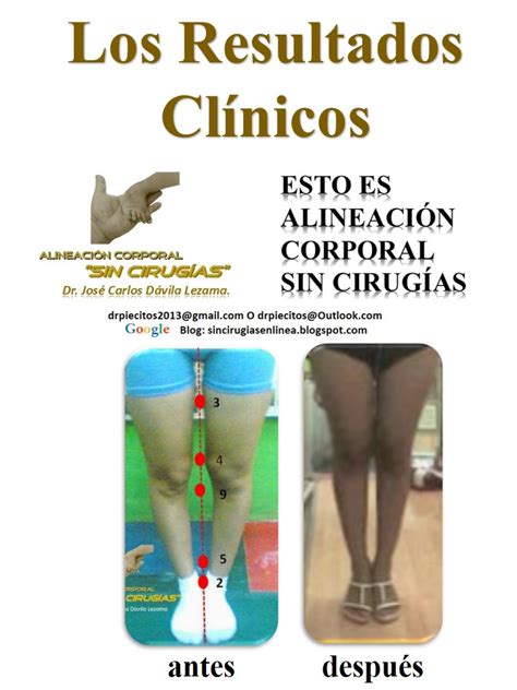 Sin CirugÍas En LÍnea Los Tres Ciclos De AlineaciÓn Corporal Sin CirugÁs