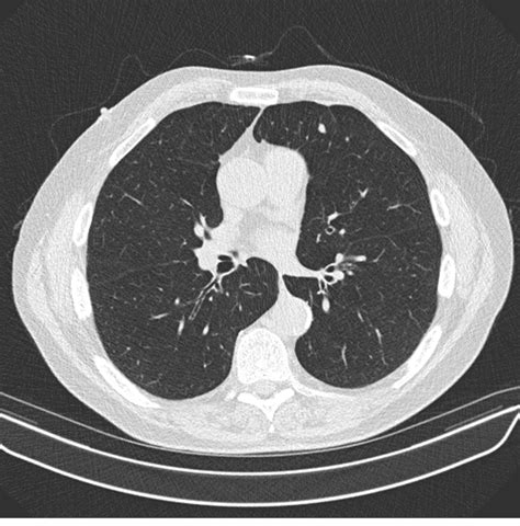 What You Need To Know About Lung Cancer Screenings Tpmg Lung And Sleep