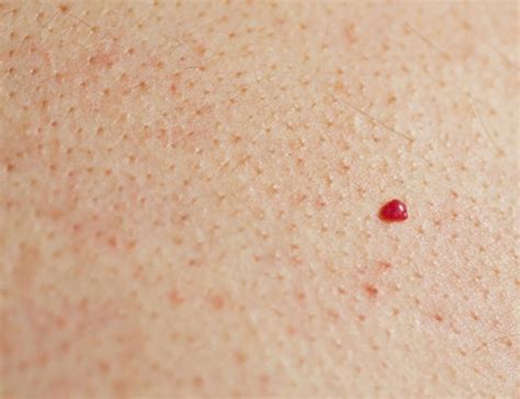 Pinpoint Red Dots On Skin Causes Tdfreeloads