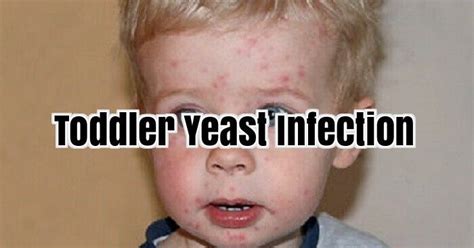 Toddler Yeast Infection Yeastinfection Toddler Yeast Infection