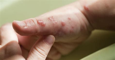 10 home remedies for fever blisters facty health