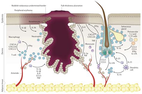 Pyoderma Gangrenosum Pathophysiology Doi 101038s41572 020 0213 X