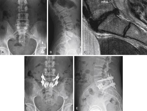 Patient Selection For Spine Surgery Neupsy Key