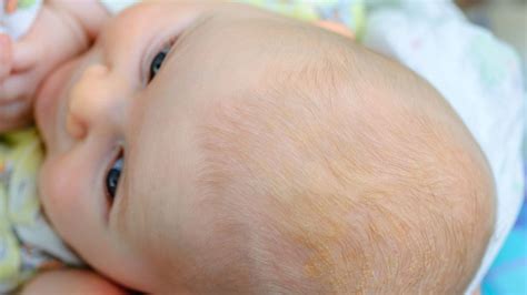 Babys Dry Scalp Treatments And Causes