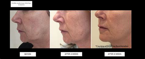 Profhilo A New Facial Filler For Rejuvenation And Skin Tightening