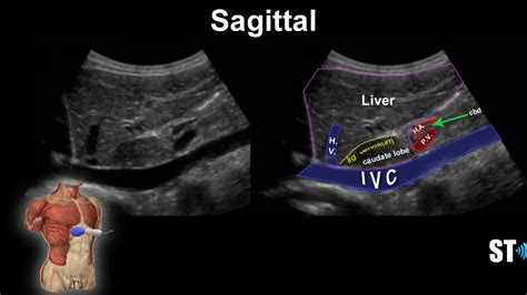 Liver Anatomy And Protocol Basics Sonographic Tendencies Liver