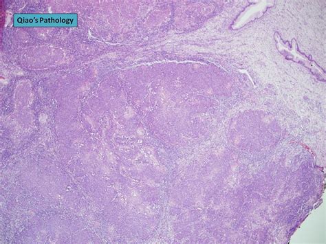 Flickriver Photoset Invasive Cervical Squamous Cell Carcinoma By