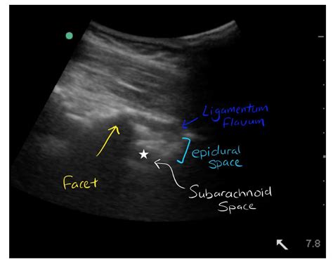 Ultrasound Guided Lumbar Puncture Core Em