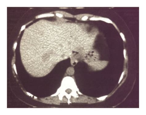 A Ct Cut From The Abdomen Showing Multiple Hypodense Lesions In The