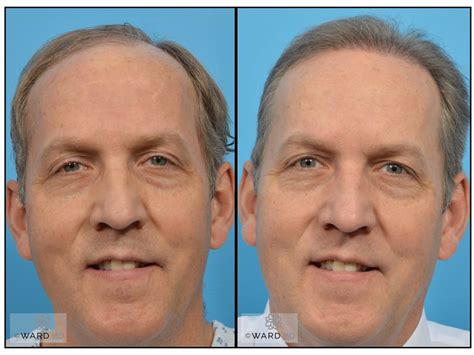 The first few months after a hair transplant can be the most frustrating. Hair Transplant Before and After Cases | Salt Lake City UT