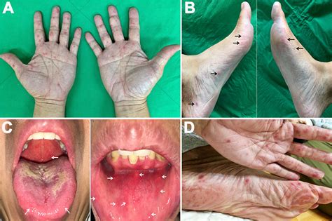 Hand Foot And Mouth Disease In Adults