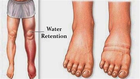 What Causes Water Retention And How To Avoid It Youtube