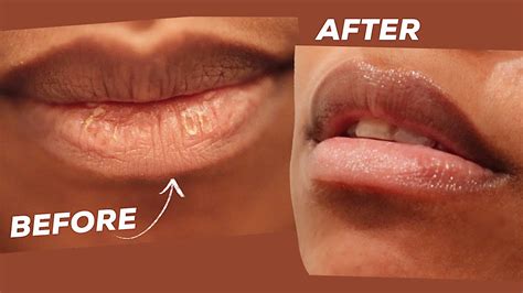 how to heal scabs on lips fast naturally