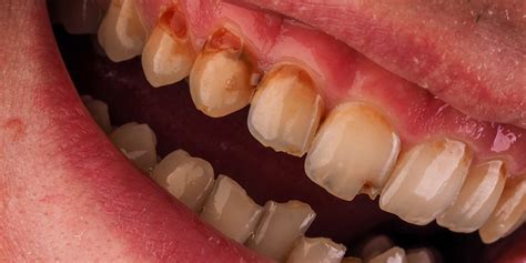 What Are The Major Signs Of Gum Disease Dr Alex Midtown Nyc