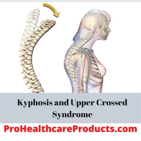 Kyphosis And Upper Crossed Syndrome