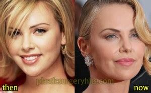 Charlize Theron Plastic Surgery Before And After Plastic Surgery Hits