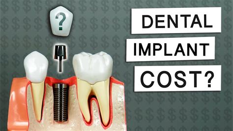 Tubs are often cheaper to install. How Much Do Dental Implants Cost? - YouTube