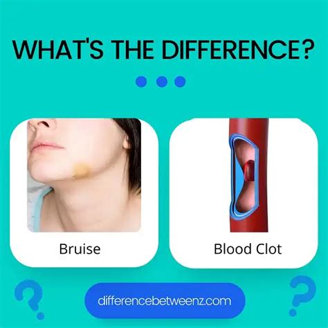 Difference Between A Bruise And A Blood Clot Difference Betweenz