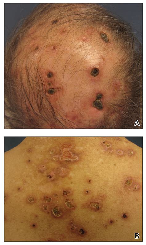 Exuberant Lymphomatoid Papulosis Of The Head And Upper Trunk Mdedge