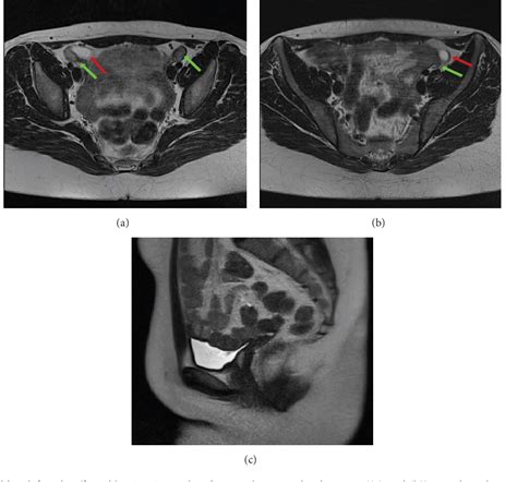 Figure 3 From Role Of Imaging In The Diagnosis And Management Of Complete Androgen Insensitivity