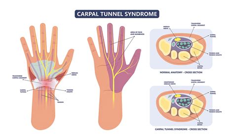 Carpal Tunnel Syndrome Albuquerque Nm Modern Pain And Spine