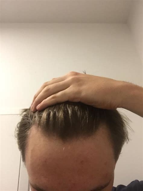 A mature hairline is a natural progression. End of December.jpeg