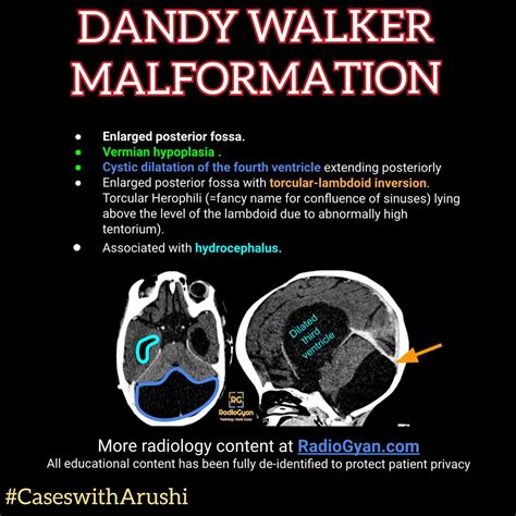 Dandy Walker Malformation Radiology Tech Week Ideas Radiology