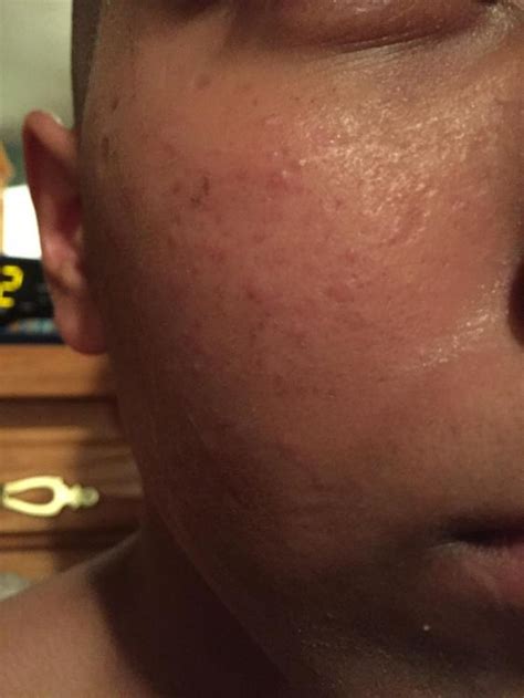 Small Red Bumps All Over Cheeks General Acne Discussion Forum